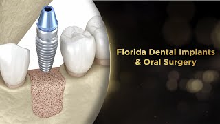 Single Dental Implant Procedure with Bone Grafting [upl. by Inihor]