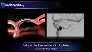 How Endovascular Stroke Treatment Works [upl. by Estis330]