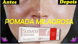 SUAVICID TUDO SOBRE A POMADA MILAGROSA PARA MANCHAS e MELASMA  SUAVICID ANTES E DEPOIS [upl. by Ruth]