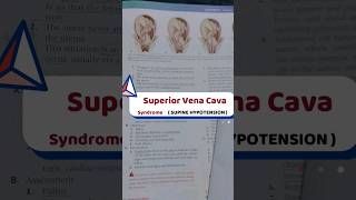 SUPINE Hypotension ✂️  Vena cava Syndrome  aiims norcet nclexrn saunders [upl. by Ontine]