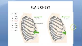 Surgery Flail Chest Paradoxical Breathing Seagull plate Rib fracture Pneumatic fixation Stove [upl. by Neelya337]