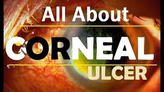 Corneal Ulcer Hindi [upl. by Nodnorb]