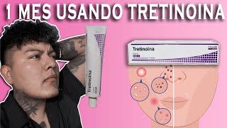 1 MES USANDO TRETINOINA ¡ Me quito las marcas de acné [upl. by Fabyola]