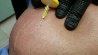 Carboxiterapia para estrias y celulitis [upl. by Inaluiak]