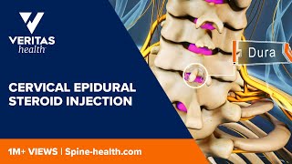 Cervical Epidural Steroid Injection [upl. by Treblihp463]