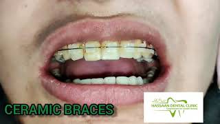 How to put Ceramic Braces on teeth Procedure 2021 [upl. by Maxie]