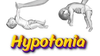 Hypotonia Symptoms Causes and Treatment [upl. by Ahsets770]