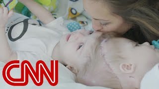 Rare surgery to separate conjoined twins [upl. by Ardnnek]