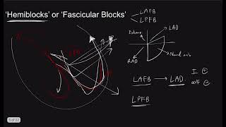 Bundle Branch Block the Series Part 2 AdvancedHemiBifascicular blocks I The Pacemaker [upl. by Ribble]