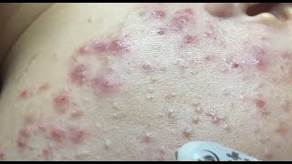 How to treat acne during pregnancy  No P4 HoangMySpa130 [upl. by Hirst]