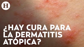 Dermatitis atópica Qué la causa cuáles son los síntomas y qué tratamientos hay  Médico H [upl. by Bouldon]