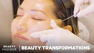 How Nonsurgical FaceLifts Work With PDO Threads  Beauty Transformations  Insider Beauty [upl. by Rossuck]