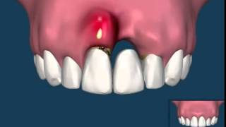 The Difference Between A Dental Bridge and Dental Implants [upl. by Gaeta999]