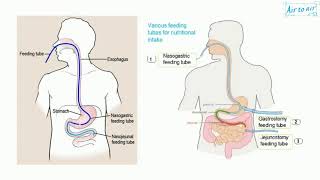 How to INSTANTLY Reduce Gut Inflammation and Leaky or Irritable Digestion Issues [upl. by Ecnerwaled]