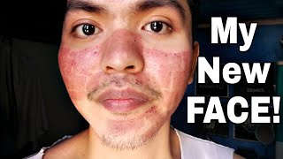 My Fractional CO2 Laser Treatment Experience TAGALOG [upl. by Jola]