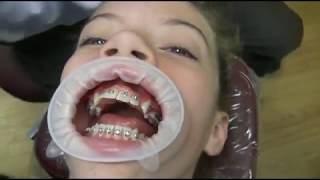 Watch how we put your braces on [upl. by Baal]