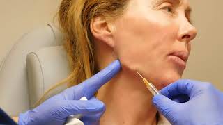 Jawline Correction with Filler with Dr Janowski [upl. by Griffy]