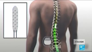 Medical breakthrough a spinal cord implant helps paralyzed patients to walk again [upl. by Aesoh]