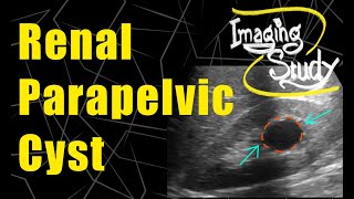 Renal Parapelvic Cyst  Bosniak GradeI  Ultrasound  Case 83 [upl. by Boulanger]