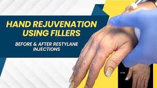 Hand Rejuvenation Using Fillers  Before amp After Restylane Injections [upl. by Hobart]