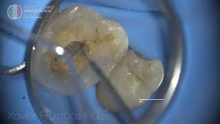 Endodontic diagnostic MB2 canal detection with Explora amp Mirror [upl. by Dorran17]