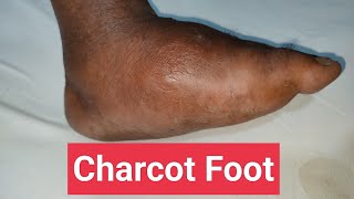 Understanding Charcot Foot in Diabetes Symptoms Treatment and Care [upl. by Hniht]