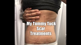 My Tummy Tuck Scar Treatments  What I use [upl. by Ynaffital818]