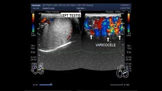 Ultrasound Video showing varicocele [upl. by Ahsinauq]