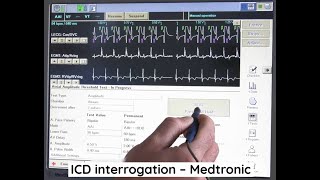 ICD interrogation  Medtronic [upl. by Plusch184]