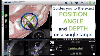 Introduction to the XGuide Dynamic 3D Navigation System [upl. by Nnaharas]