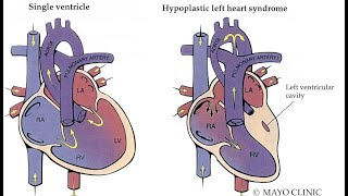 Myelodysplastic syndromes  causes symptoms diagnosis treatment pathology [upl. by Raye]