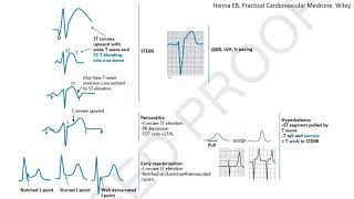 ST elevation on ECG part 1 Differential diagnosis and case studies STEMI mimickers subtle STEMI [upl. by Nacul199]