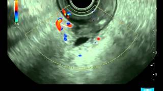 Endoscopic Ultrasound Examination of the Papilla and the Biliary System [upl. by Alexis]