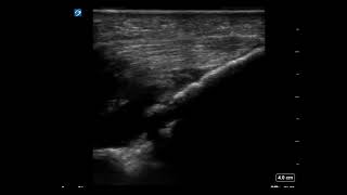 Elbow Ultrasound Arthrocentesis [upl. by Eicnan]