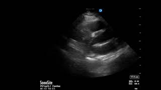 Pulmonary Embolisms causes symptoms diagnosis treatment pathology [upl. by Larrisa]