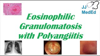 Eosinophilic Pneumonia Explained Clearly by MedCramcom [upl. by Alison]