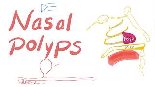 Nasal Polyps Allergic Rhinitis and Cystic Fibrosis [upl. by Pape]