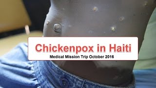 Chickenpox or Varicella in Haiti [upl. by Nitsug]