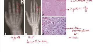 Ollier Disease and Maffucci Syndrome [upl. by Anzovin]