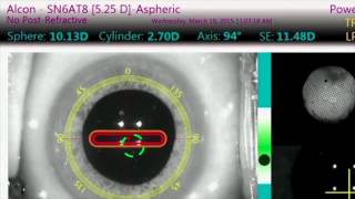 Understanding ORA Intraoperative Aberrometry at UCLA [upl. by Sibel]