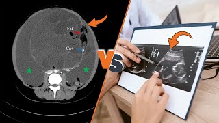 Ovarian Cyst Diagnosis CT Scan vs Ultrasound [upl. by Leander]