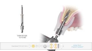 Guided surgery Astra Tech Implant System ® EV [upl. by Vachel]