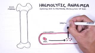 Haemolytic Anaemia  classification intravascular extravascular pathophysiology investigations [upl. by Terag]