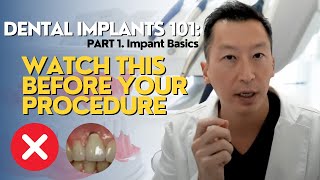 Dental Implants 101 What You NEED to Know Part 1 Implant Basics [upl. by Fen]