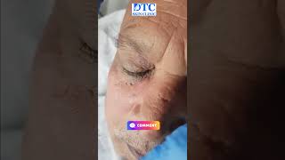 Watch Our Skin Tag Removal Procedure at DTC Skin Clinic [upl. by Fleur]