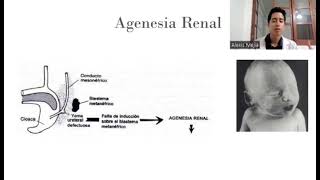 Agenesia Renal [upl. by Poole418]