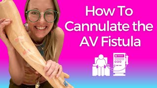 Dialysis Nursing How to Cannulate the AV FISTULA [upl. by Anilehcim363]