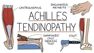 Understanding Achilles Tendinopathy Achilles Tendinitis [upl. by Roon]