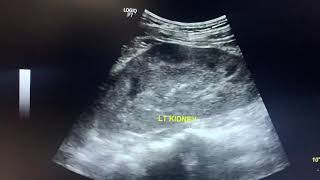 Ultrasound acute pyelonephritis [upl. by Dnomal]