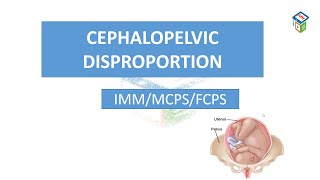 CPD  cephalopelvic disproportion  cpsp format  mcqs  labour module [upl. by Jamey382]